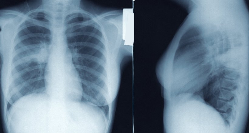 Medical x-rays of lungs, anteroposterior on the left, lateral on the right