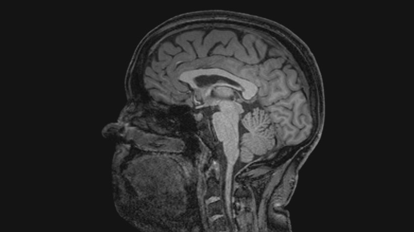 Black and white MRI scan of a patient with Alzheimers brain