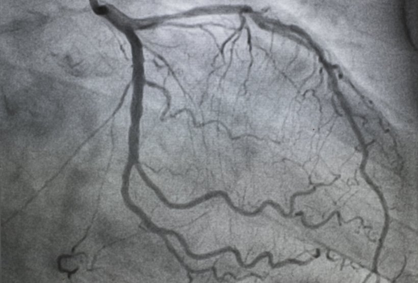 Angiogram of the heart, showing blood flow through dark vessels