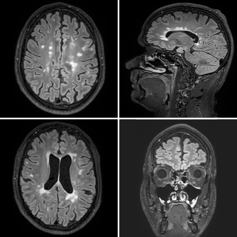 Vier MRT-Scans eines Gehirns mit weißen Flecken, die von MS verursachte...
