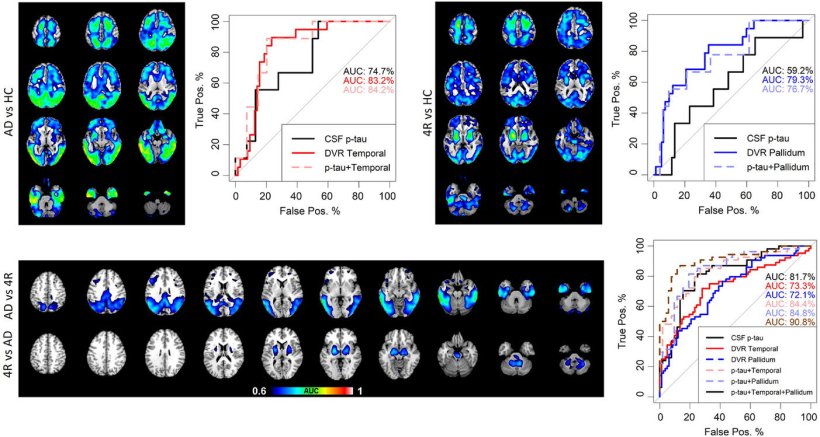 Comparison of brain scans of diseased and healthy patients