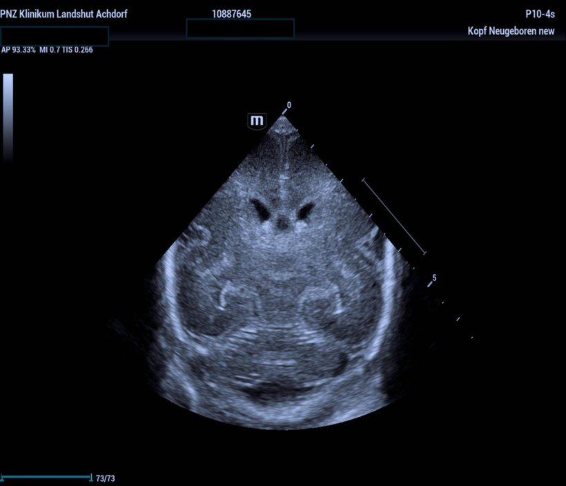 Ultraschall-Aufnahme vom Schädel eines Neugeborenen