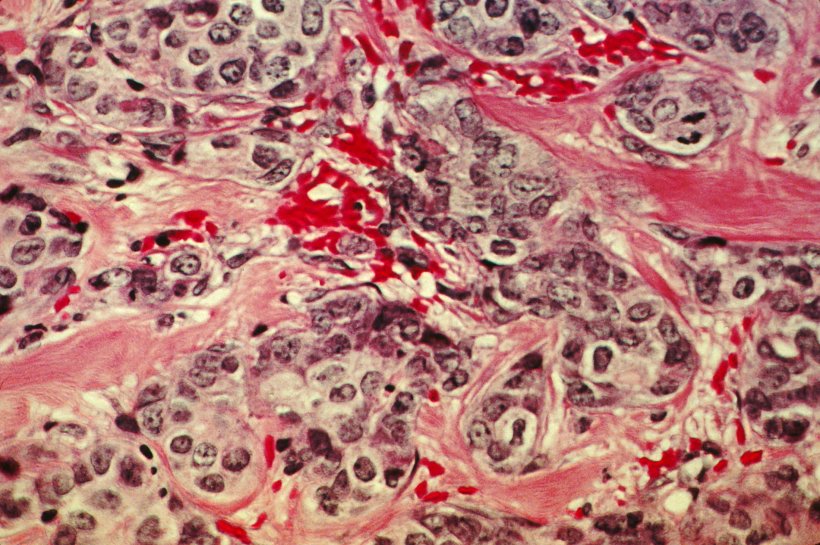 Pink and red tissue from patient with breast cancer