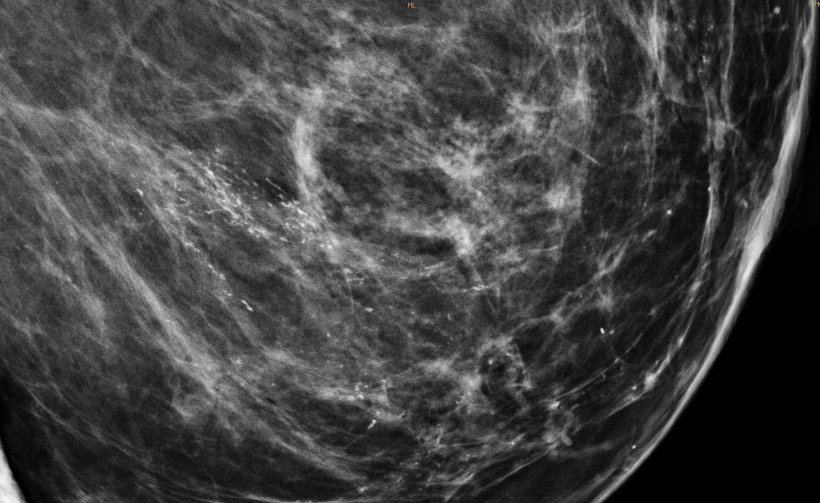 Mammogram of a woman with the breast cancer precursor DCIS