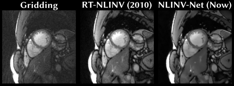 Three MRI scans of the human heart