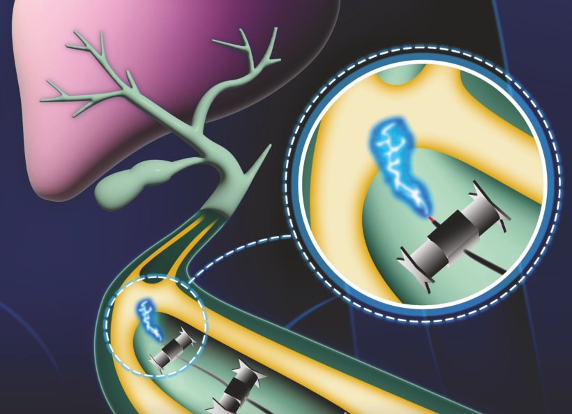 In an illustration, small electrified robots travel through a bile duct towards...