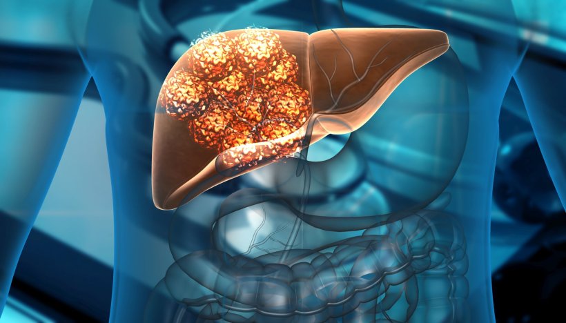 Leberkrebs: Immunologische Marker entscheiden Erfolg von Checkpoint-Inhibitoren