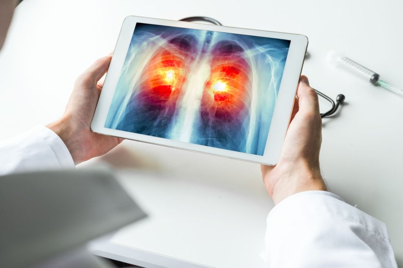 Study reveals respiratory conditions may delay lung cancer diagnoses