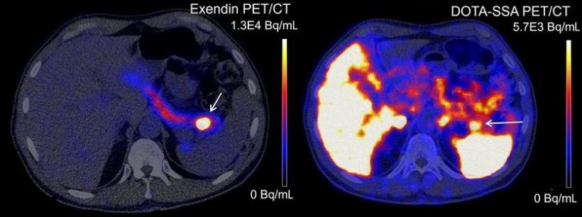 Two PET/CT scans of the pancreas