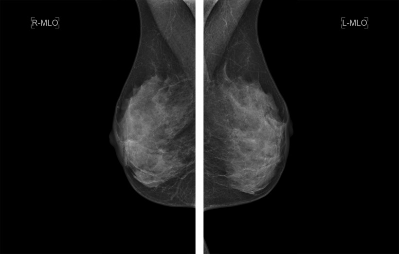 Mammography