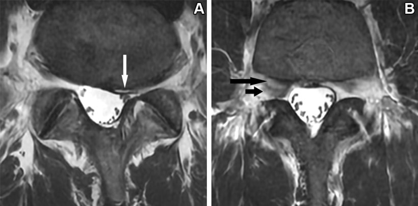 Two MRI scans of a patients spine, with suspicious areas indicated by arrows