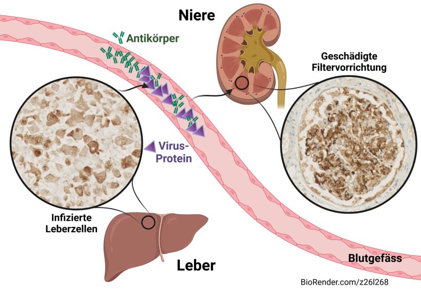 Schematische Darstellung, wie eine Infektion mit Hepatitis E auf die Niere wirkt