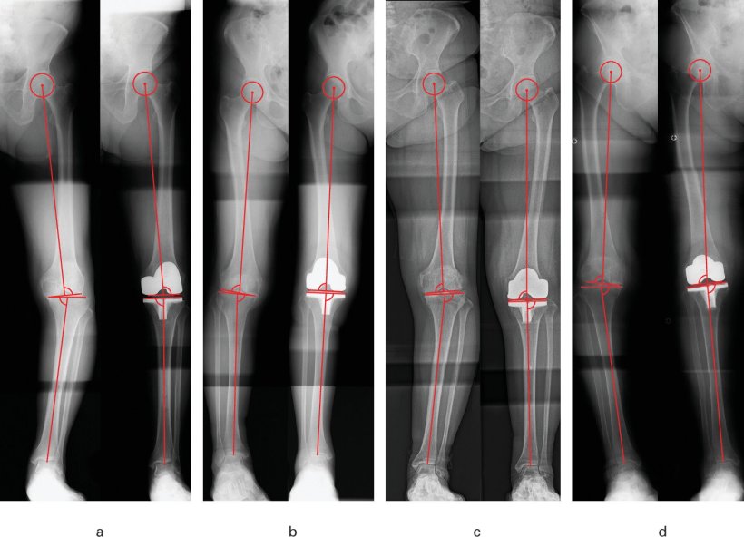 Several xray images from legs, with red lines and circles indicating knee...