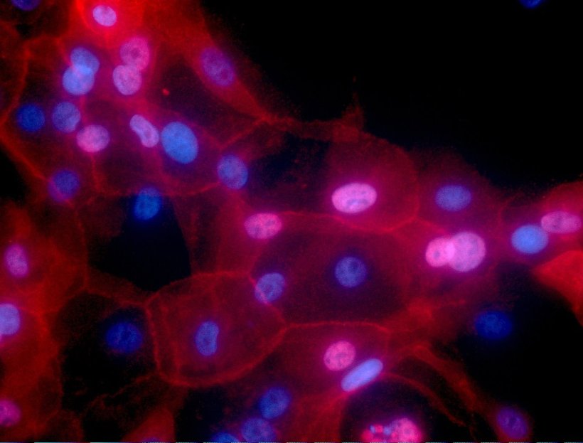 Fluoresizierende Brustkrebs-Zellen unter dem Mikroskop