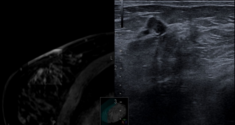 Image fusion of MRI with ultrasound for IEL