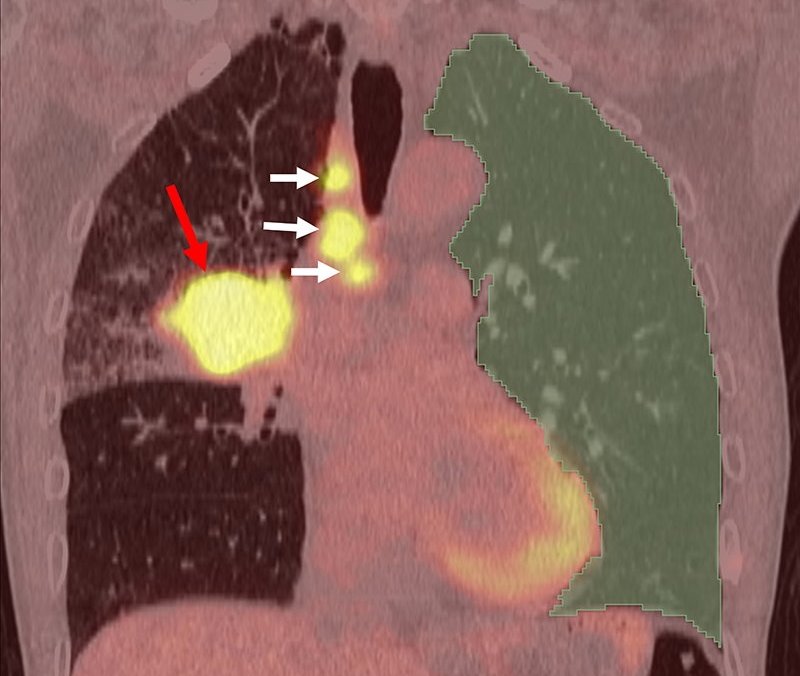 PET-CT image of human lungs with areas of inflammation highlighted in yellow