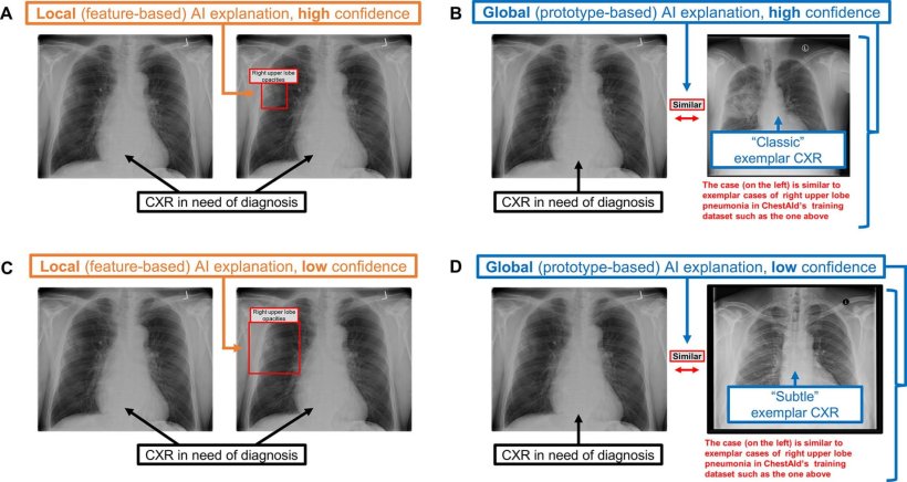 Chest radiograph (CXR) examples of (A, C) local (feature-based) AI explanations...