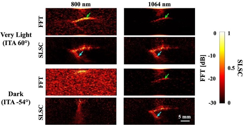 Photoacoustic images of a splayed vessel structure underlying very light and...