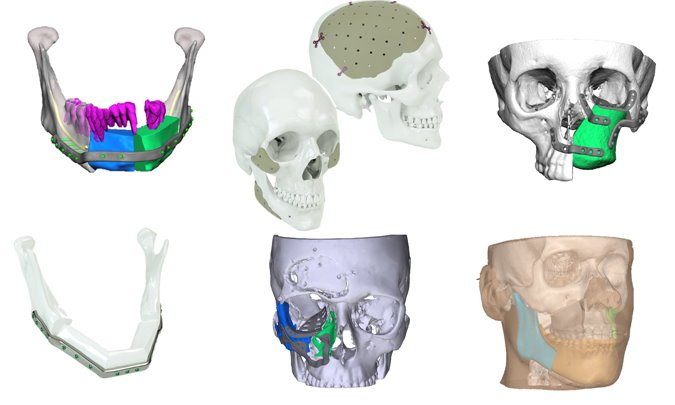 3D-Modelle medizinischer Implantate für Mund-, Kiefer- und Gesichtschirurgie