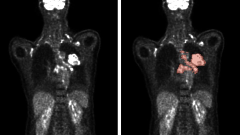 Automatische Verfahren ermöglichen die Analyse von PET/CT-Scans (links) zur...