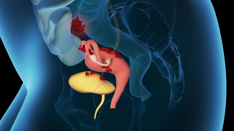 3D-Darstellung der Anatomie des weiblichen Unterleibs bei Endometriose