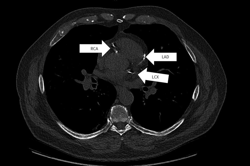 Chest CT scan with white arrows marking signs of coronary artery disease