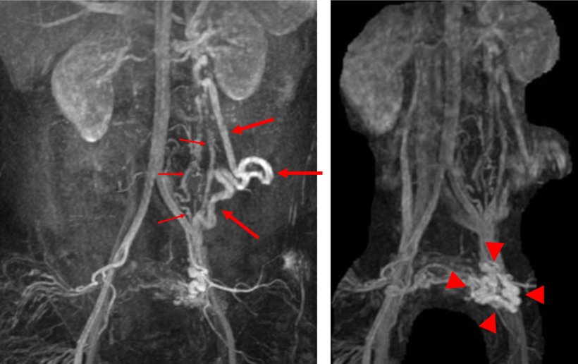 Zwei MRT-Aufnahmen des Abdomens einer Frau. Rote Pfeile weisen auf krankhaft...