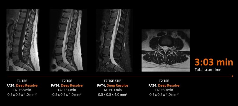 Fast routine spine imaging with Deep Resolve on planned Siemens Healthineers...