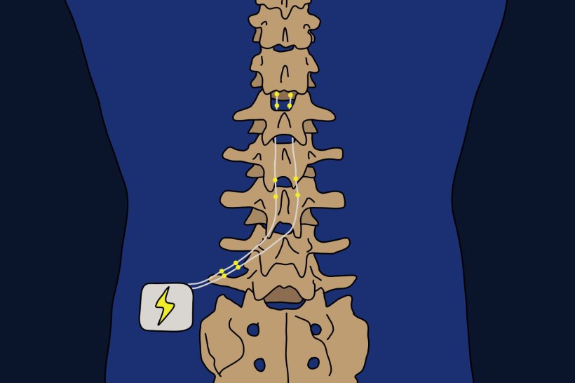 Illustration of a human spine with stylized electrods and a lightning bolt...