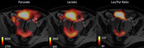 These images, from a small-scale unpublished study in human ovarian cancer...