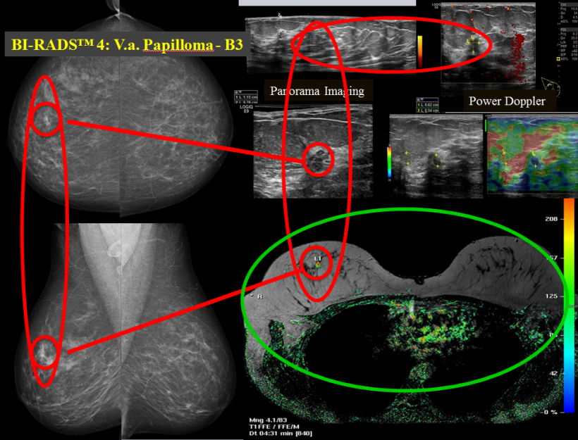 Complementary breast diagnostics: mammography, ultrasound, power Doppler,...