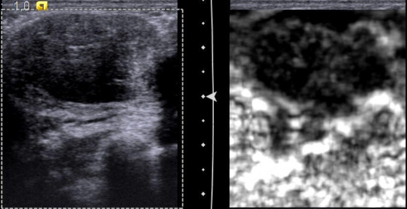 Fibroadenoma with typical ‘salt and pepper’ image in real time elastography