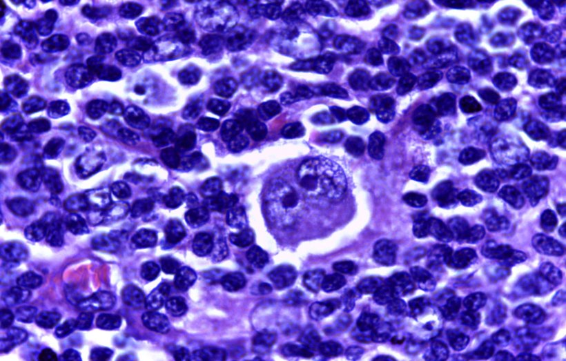 Micrograph of a lymph node in Hodgkins lymphoma with characteristic...