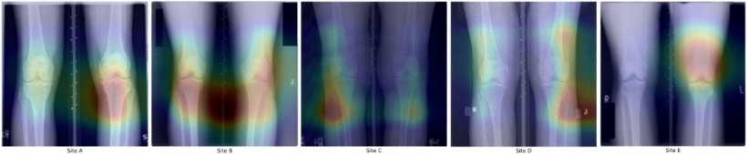 Using knee X-rays from the Osteoarthritis Initiative, researchers demonstrated...