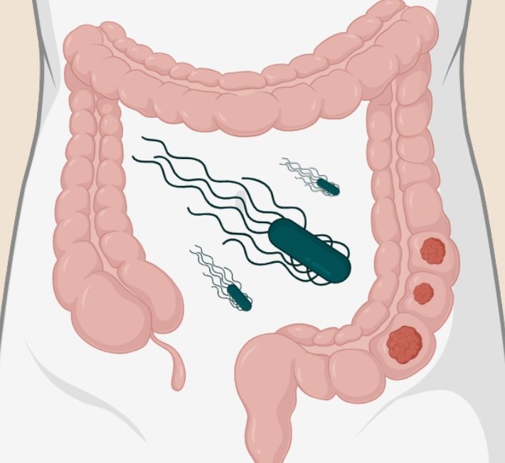 Illustration of human intestine, with oversized Salmonella bacteria depicted in...