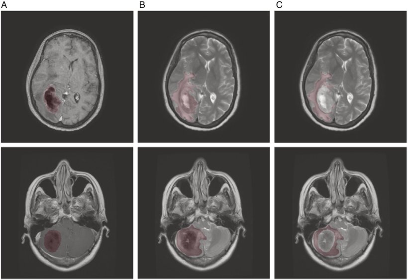 Six MRI images of a human brain with cancer