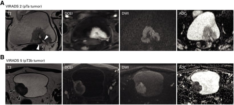 Bladder cancer: MRI scanning and biopsy as shortcut to correct treatment