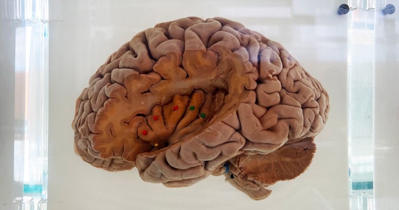 A human brain preserved in liquid