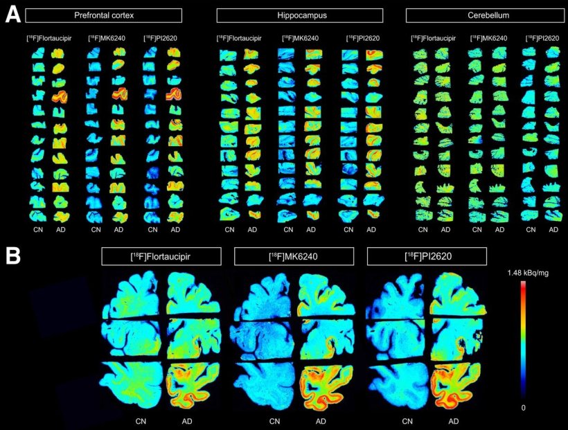 Alzheimers disease: New radiotracers for better detection