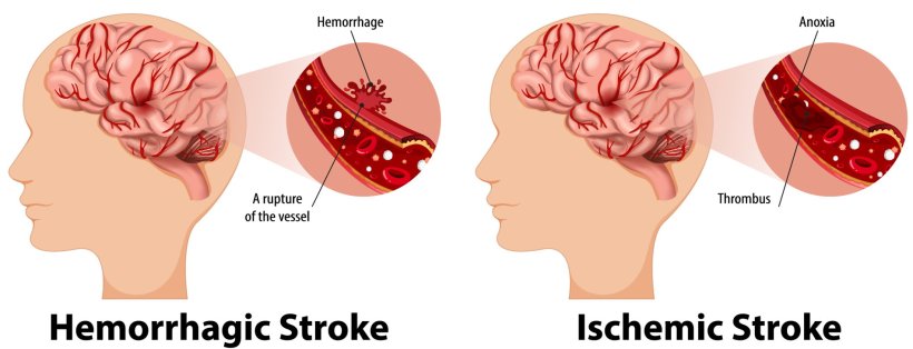 Infographic explaining the difference between a hemorrhagic or ischemic stroke