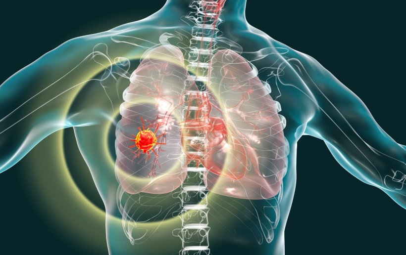 3D illustration of a transparent human body, with visible lungs, affected by...