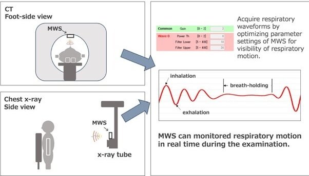 Millimeter-wave sensor (MWS) developed to non-invasively monitor respiratory...