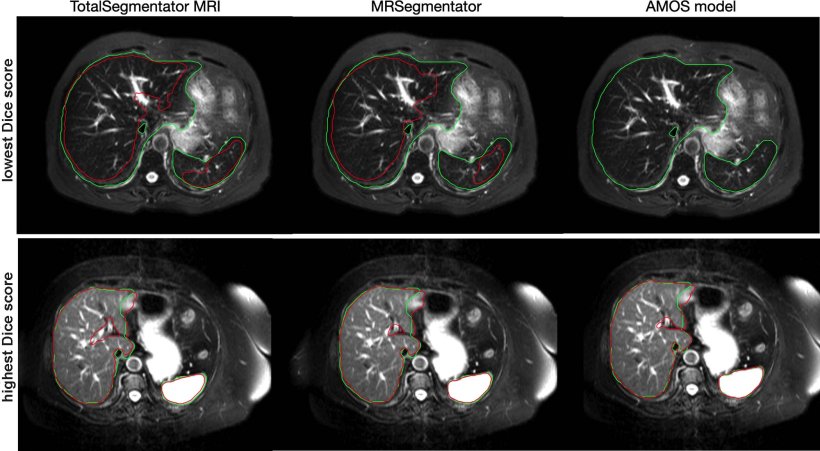 MRI images of the human abdomen, with AI-generated segmentation markers,...