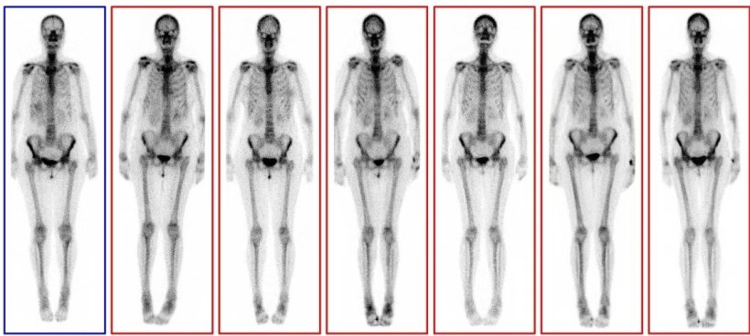 Acht Szintigrafie-Bilder eines menschlichen Skeletts