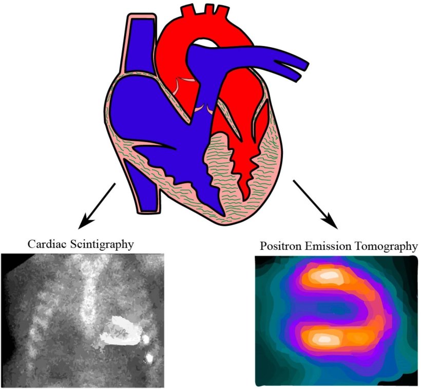 Illustration of nuclear imaging modalities for cardiac amyloidosis: Nuclear...