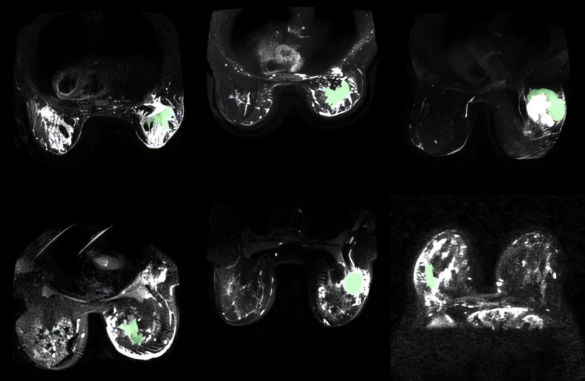 Several MRI images developed by the Waterloo research team show how cancerous...