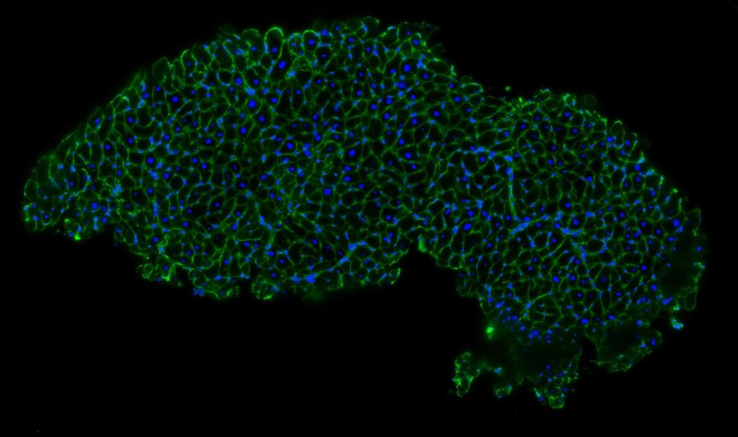 Herzbiopsie von einem Patienten mit Covid-19. Mithilfe neuer Technologien kann...