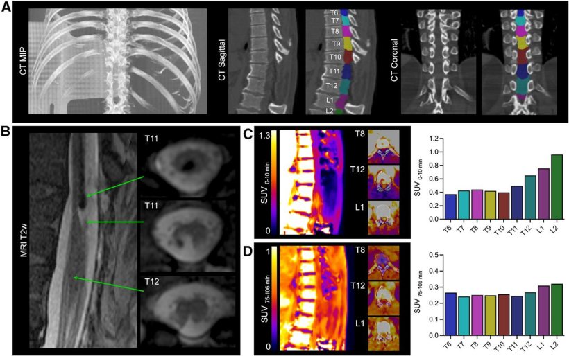 PET tracer offers new insights into spinal cord injuries