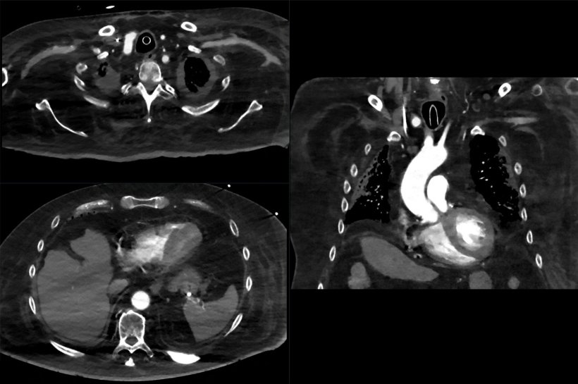 Pronounced fatty muscle atrophy in a patient with amyotrophic lateral sclerosis...