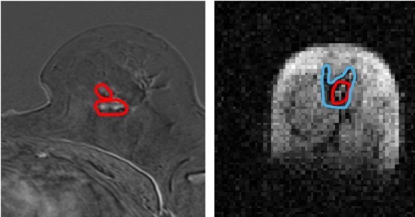 Side by side image of same breast tissue in MRI (left) and FCI (right). MRI...